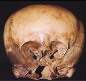 Impactantes resultados de ADN muestran que el cráneo Starchild es alienígena